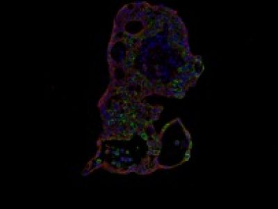 DOUBLE IMMUNOSTAINING VILLIN 1 & CYTOKERATIN 19 (PARAFFIN)